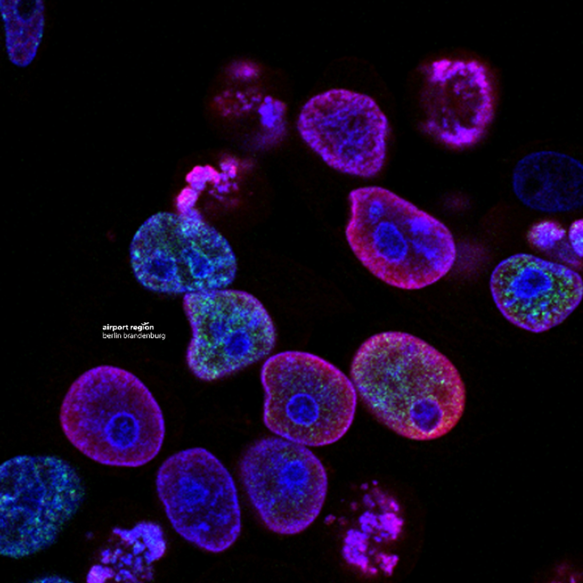 Bild zeigt Krebszellen unter einem Mikroskop.